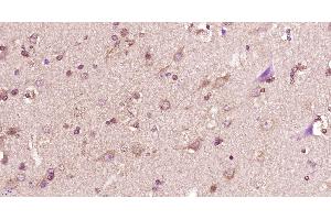 Paraformaldehyde-fixed, paraffin embedded human glioma, Antigen retrieval by boiling in sodium citrate buffer (pH6) for 15min, Block endogenous peroxidase by 3% hydrogen peroxide for 30 minutes, Blocking buffer (normal goat serum) at 37°C for 20min, Antibody incubation with 14-3-3 beta Polyclonal Antibody, Unconjugated  at 1:400 overnight at 4°C, followed by a conjugated secondary and DAB staining. (YWHAB antibody  (AA 51-150))