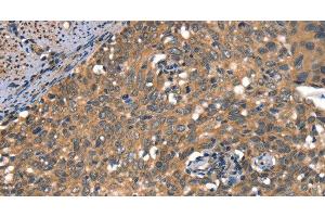 Immunohistochemistry of paraffin-embedded Human cervical cancer using DAAM1 Polyclonal Antibody at dilution of 1:50