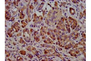 IHC image of ABIN7145595 diluted at 1:500 and staining in paraffin-embedded human pancreatic cancer performed on a Leica BondTM system. (Cholesterol Esterase antibody  (AA 661-753))