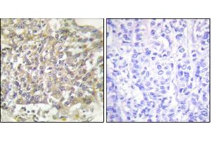 Immunohistochemical analysis of paraffin-embedded human breast carcinoma tissue using Shc (Ab-349) antibody. (SHC1 antibody)