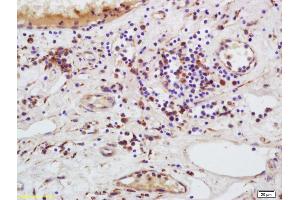 Formalin-fixed and paraffin embedded human bladder carcinoma labeled with Anti-MMRN1/ECM Polyclonal Antibody, Unconjugated (ABIN1385517) at 1:200 followed by conjugation to the secondary antibody and DAB staining (Multimerin 1 antibody  (AA 895-930))