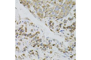Immunohistochemistry of paraffin-embedded human lung cancer using IRF1 antibody. (IRF1 antibody)