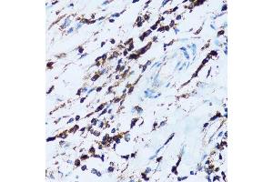 Immunohistochemistry of paraffin-embedded human breast cancer using SPN antibody. (CD43 antibody  (AA 276-400))