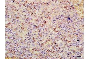 Formalin-fixed and paraffin embedded human colon cancer labeled with Anti-ATF3 Polyclonal Antibody, Unconjugated (ABIN669561) at 1:200 followed by conjugation to the secondary antibody and DAB staining (ATF3 antibody  (AA 51-150))
