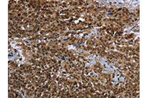 The image on the left is immunohistochemistry of paraffin-embedded Human cervical cancer tissue using ABIN7191991(PRDM2 Antibody) at dilution 1/25, on the right is treated with synthetic peptide. (PRDM2 antibody)