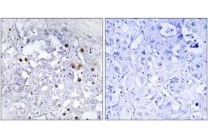 Immunohistochemistry analysis of paraffin-embedded human liver carcinoma, using HNF4 alpha (Phospho-Ser313) Antibody. (HNF4A antibody  (pSer313))