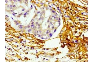 Immunohistochemistry of paraffin-embedded human breast cancer using ABIN7145679 at dilution of 1:100 (BMP1 antibody  (AA 317-424))