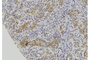 ABIN6279230 at 1/100 staining Human lung cancer tissue by IHC-P. (CALML5 antibody  (Internal Region))