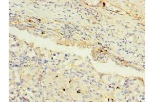 Immunohistochemistry of paraffin-embedded human lung cancer using ABIN7159277 at dilution of 1:100 (MAGEA9 antibody  (AA 1-315))