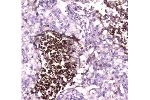IHC analysis of Lactoferrin using anti-Lactoferrin antibody . (Lactoferrin antibody  (AA 529-710))
