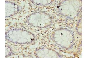 Immunohistochemistry of paraffin-embedded human colon cancer using ABIN7169603 at dilution of 1:100