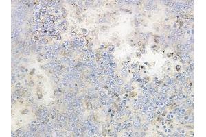 ABIN6262427 and ABIN6268846 at 1/100 staining human melanoma by IHC-P.