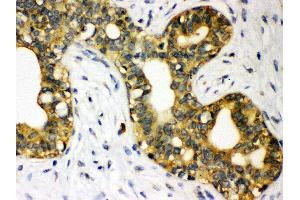 Anti- STAT1 Picoband antibody, IHC(P) IHC(P): Human Mammary Cancer Tissue (STAT1 antibody  (N-Term))