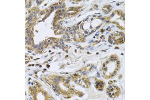 Immunohistochemistry of paraffin-embedded human breast cancer using DRD3 Antibody. (DRD3 antibody)