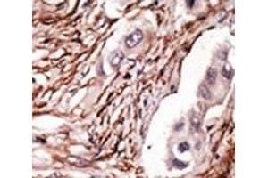 IHC analysis of FFPE human breast carcinoma tissue stained with the NOTCH3 antibody (NOTCH3 antibody  (AA 2291-2321))