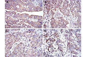Immunohistochemical analysis of paraffin-embedded human rectum cancer tissue (A), liver cancer tissue (B), lung cancer tissue (C) and stomach cancer tissue (D) using PHB monoclonal antobody, clone 5H7  with DAB staining. (Prohibitin antibody)