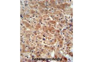 ASAP3 antibody (N-term) immunohistochemistry analysis in formalin fixed and paraffin embedded human hepatocarcinoma followed by peroxidase conjugation of the secondary antibody and DAB staining.