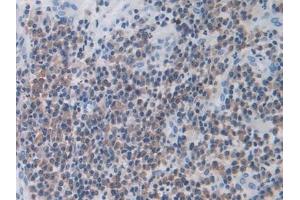 Detection of MX1 in Human Skin cancer Tissue using Polyclonal Antibody to Myxovirus Resistance 1 (MX1) (MX1 antibody  (AA 80-342))