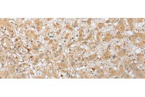 Immunohistochemistry of paraffin-embedded Human liver cancer tissue using FNDC3B Polyclonal Antibody at dilution of 1:45(x200) (FNDC3B antibody)