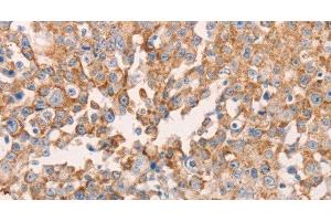 Immunohistochemistry of paraffin-embedded Human breast cancer using GNA11 Polyclonal Antibody at dilution of 1:40 (GNA11 antibody)