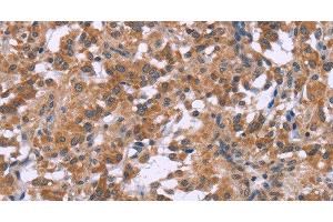 Immunohistochemistry of paraffin-embedded Human thyroid cancer tissue using GNPAT Polyclonal Antibody at dilution 1:40