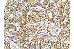 ABIN7095645 and ABIN7099707 at 1/100 staining human colorectal cancer by IHC-P.