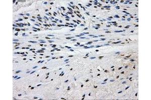 Immunohistochemical staining of paraffin-embedded Carcinoma of liver tissue using anti-L1CAMmouse monoclonal antibody. (L1CAM antibody)
