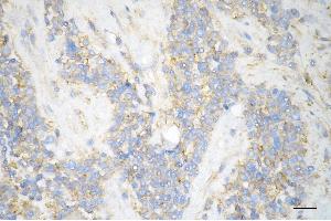 Immunohistochemistry was performed on paraffin-embedded human breast carcinoma using ARPC2 antibody (ABIN7797453), 1:200).