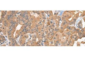 Immunohistochemistry of paraffin-embedded Human thyroid cancer tissue using BCAN Polyclonal Antibody at dilution of 1:35(x200)