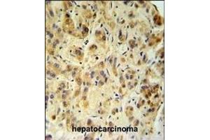 FUCA1 Antibody (Center) (ABIN390762 and ABIN2841020) IHC analysis in formalin fixed and paraffin embedded human hepatocarcinoma followed by peroxidase conjugation of the secondary antibody and DAB staining. (FUCA1 antibody  (AA 265-294))