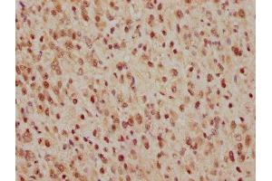 IHC image of ABIN7127412 diluted at 1:165 and staining in paraffin-embedded human glioma cancer performed on a Leica BondTM system. (Recombinant CDC25C antibody)