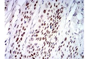 Immunohistochemical analysis of paraffin-embedded esophageal cancer tissues using UFD1L mouse mAb with DAB staining. (UFD1L antibody  (AA 208-307))