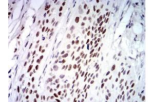 Immunohistochemical analysis of paraffin-embedded esophageal cancer tissues using UFD1L mouse mAb with DAB staining.