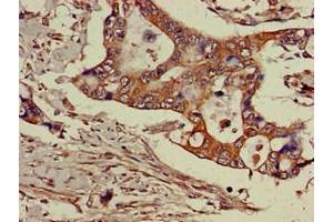 Immunohistochemistry of paraffin-embedded human pancreatic cancer using ABIN7143469 at dilution of 1:100 (GGA3 antibody  (AA 342-503))