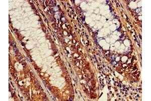 Immunohistochemistry of paraffin-embedded human colon cancer using ABIN7170052 at dilution of 1:100 (ATP1B3 antibody  (AA 57-279))