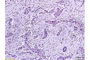 Formalin-fixed and paraffin embedded human tumor tissue labeled with : Anti-HPV16-E6 Polyclonal Antibody, Unconjugated (ABIN730618) at 1:200, followed by conjugation to the secondary antibody and DAB staining (Human Papilloma Virus 16 E6 (HPV-16 E6) (AA 85-158) antibody)