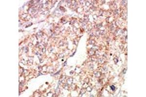 IHC analysis of FFPE human hepatocarcinoma tissue stained with the EphA1 antibody (EPHA1 antibody  (AA 29-60))
