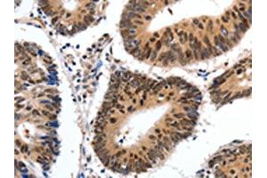 The image on the left is immunohistochemistry of paraffin-embedded Human colon cancer tissue using ABIN7190308(CMTM3 Antibody) at dilution 1/20, on the right is treated with synthetic peptide. (CMTM3 antibody)
