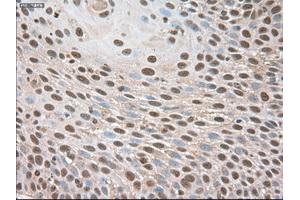 Immunohistochemical staining of paraffin-embedded Adenocarcinoma of breast using anti-Trim33 (ABIN2452535) mouse monoclonal antibody.