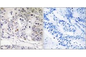 Immunohistochemistry analysis of paraffin-embedded human colon carcinoma tissue, using UBTD1 Antibody. (UBTD1 antibody  (AA 151-200))