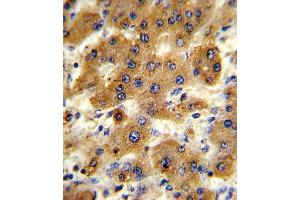 Formalin-fixed and paraffin-embedded human hepatocarcinoma reacted with CYP8B1 Antibody (C-term), which was peroxidase-conjugated to the secondary antibody, followed by DAB staining. (CYP8B1 antibody  (C-Term))