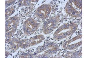 IHC-P Image Immunohistochemical analysis of paraffin-embedded human colon carcinoma, using C14orf94, antibody at 1:500 dilution. (C14orf94 antibody)