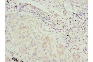 Immunohistochemistry of paraffin-embedded human lung cancer using ABIN7169217 at dilution of 1:100