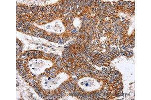 Immunohistochemistry of Human ovarian cancer using MAP2K5 Polyclonal Antibody at dilution of 1:40