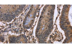 Immunohistochemistry of paraffin-embedded Human colon cancer using DCP1A Polyclonal Antibody at dilution of 1:50 (DCP1A antibody)