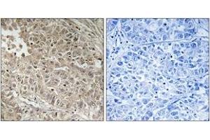 Immunohistochemistry analysis of paraffin-embedded human liver carcinoma tissue, using ABCC13 Antibody. (ABCC13 antibody  (AA 56-105))