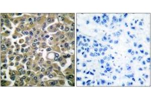 Immunohistochemistry analysis of paraffin-embedded human breast carcinoma tissue, using Keratin 16 Antibody. (KRT16 antibody  (AA 421-470))