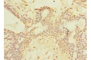 Immunohistochemistry of paraffin-embedded human breast cancer using ABIN7169911 at dilution of 1:100