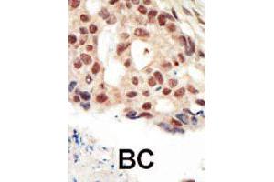 Formalin-fixed and paraffin-embedded human cancer tissue reacted with PRKG2 polyclonal antibody  , which was peroxidase-conjugated to the secondary antibody, followed by AEC staining. (PRKG2 antibody  (C-Term))