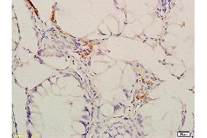 Formalin-fixed and paraffin embedded human colon carcinoma labeled with Anti-Phospho-CaMKII (Thr286) Polyclonal Antibody, Unconjugated (ABIN732473) at 1:200 followed by conjugation to the secondary antibody and DAB staining. (CAMK2B antibody  (pThr287))